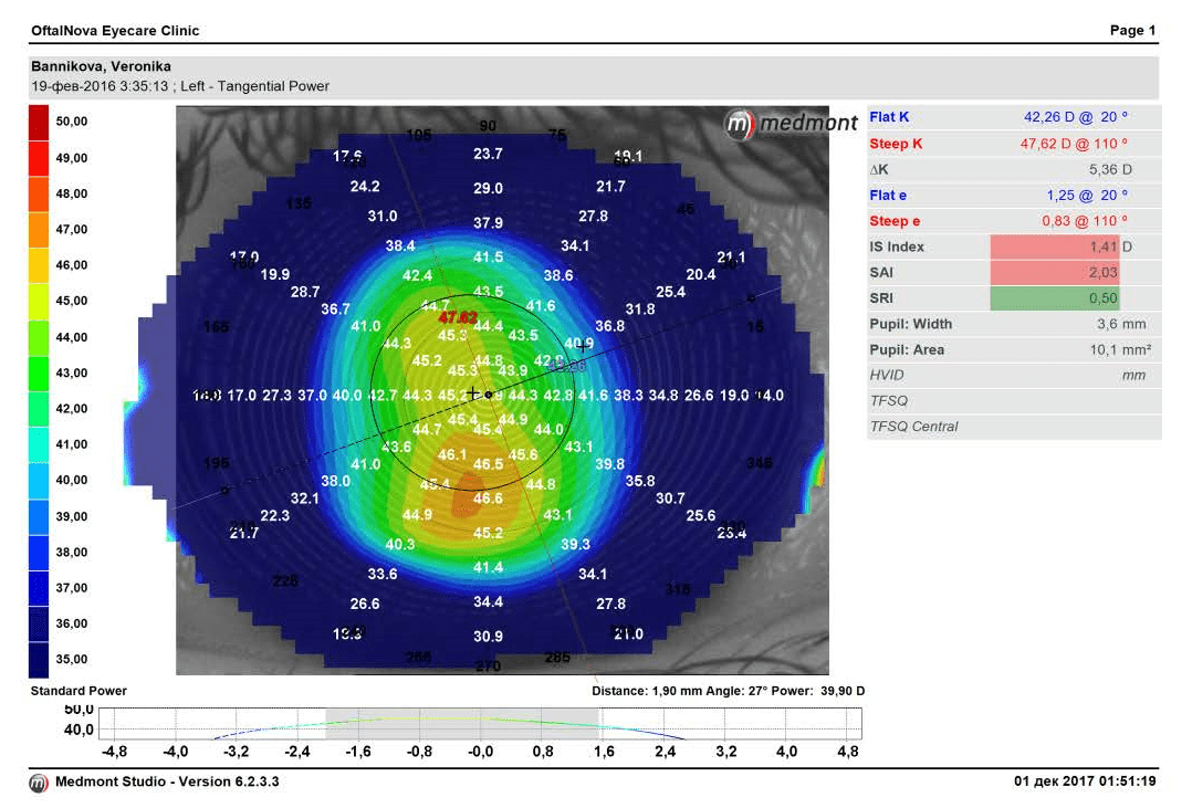 Сложный гиперметропический астигматизм, амблиопия IIст. - SkyOptix