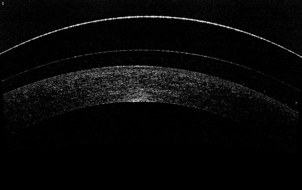 Сложный гиперметропический астигматизм, амблиопия IIст. - SkyOptix
