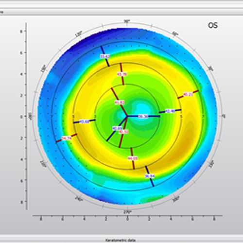OU – Миопия средней степени - SkyOptix