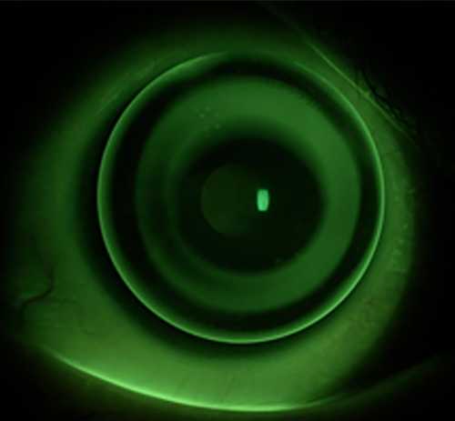 Миопия средней степени лечение в Москве. Цены